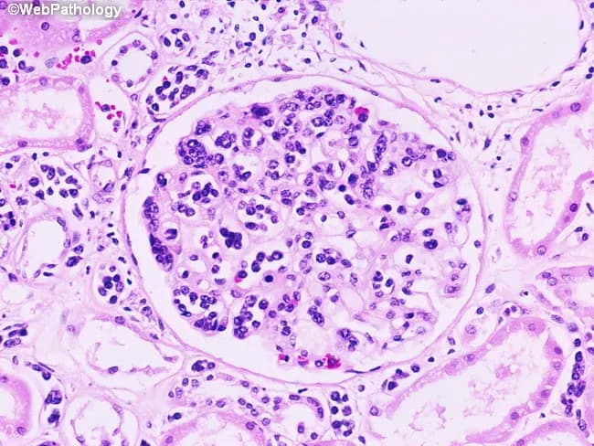 Imaging modality: Histopathology, brightfield light microscopy of hematoxylin and eosin–stained renal tissue from a kidney biopsy. The primary subject is intravascular large B-cell lymphoma (IVLBCL) involving the kidney, with conspicuous localization of neoplastic lymphocytes within glomerular capillaries. The glomerulus shows densely packed, round to irregular lymphoid cells occupying intravascular lumina, often compressing capillary loops. The surrounding glomerular tuft is variably preserved; endothelial cells may be reactive, without overt basement membrane destruction. Nuclear morphology is pleomorphic with prominent nucleoli and scant cytoplasm; mitotic figures may be present. Extracapillary invasion is limited in this field. This intravascular pattern argues for IVLBCL over typical glomerulonephritis and may be associated with minimal change disease clinically. Immunohistochemical confirmation (not shown) would demonstrate CD20 positivity and B-cell markers, with relative absence of T-cell markers, supporting a B-cell neoplasm. Diagnostic significance rests on recognizing renal involvement as part of systemic IVLBCL; confirms disease and informs staging and chemoimmunotherapy (R-CHOP). Clinical correlation includes possible renal dysfunction, nephrotic syndrome, or minimal change disease, with cutaneous, CNS, pulmonary, hepatic, and adrenal involvement reported in IVLBCL. Potential use cases include differential diagnosis of nephrotic-range proteinuria with atypical histology and guiding targeted therapy. This image exemplifies diagnostic pathology guiding timely therapy decisively.