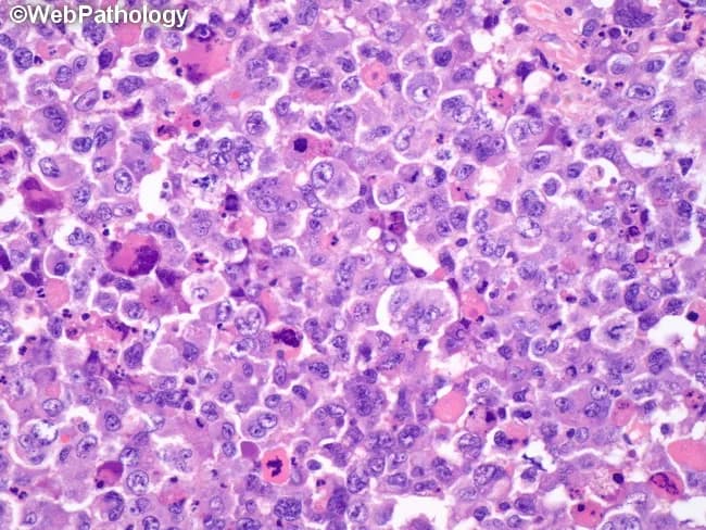 This is a high-magnification brightfield histology image of a hematopoietic tissue section stained with Hematoxylin and Eosin (H&E). The sample appears to be bone marrow with cellularity markedly increased and effacement of normal marrow architecture by an expansive population of immature hematopoietic cells. The predominant cells are blasts or blast-like cells with high nuclear-to-cytoplasmic ratio, rounded to oval nuclei, finely to coarsely stippled chromatin, and prominent nucleoli in several cells. Cytoplasm is scant to variable; mitotic figures are occasionally seen. Background elements such as mature erythroid, myeloid, and megakaryocytic precursors are reduced or obscured. Occasional macrophages and debris can be identified; there is no clear architectural adipose framework visible. Auer rods are not definitively seen in this field. The morphological pattern is compatible with an acute hematologic neoplasm, most consistent with acute leukemia or high-grade lymphoblastic/lymphoid proliferation; definitive classification requires immunophenotyping (flow cytometry), cytogenetics, and molecular testing. Clinically, such findings correlate with bone marrow failure symptoms (pancytopenia) and systemic signs like fever; differential includes AML, ALL, mixed-phenotype leukemia, and high-grade lymphoma with marrow involvement. This image is valuable for educational reference, diagnostic differential, and serves as a teaching exemplar for hematopathology board review.