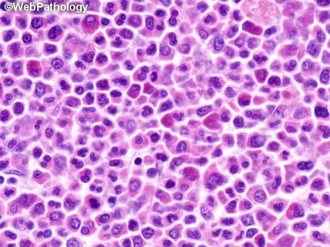 This high-magnification light microscopy image shows an H&E stained tissue section documenting an extramedullary myeloid tumor (myeloid sarcoma) composed of immature myeloid precursors arranged in diffuse sheets. The cellular population includes myeloblasts with high nuclear-to-cytoplasmic ratio, fine nuclear chromatin, prominent nucleoli, and frequent mitotic figures, accompanied by promyelocytes and maturation to myelocytes in variable proportions. Cytoplasm is scant to moderate and can contain occasional cytoplasmic granules; rod-shaped inclusions (Auer rods) may be seen in scattered blasts. The architectural pattern lacks normal tissue stratification, with cohesive clusters and dispersed cells infiltrating the stroma, consistent with an extramedullary granulocytic tumor. The image corresponds to a histopathology specimen most often obtained from soft tissue, lymph node, skin, or other extramedullary sites in patients with or without overt bone marrow involvement. Clinically, myeloid sarcoma is diagnostic of acute myeloid leukemia (AML) and often precedes or heralds AML relapse; immunohistochemical profiling (MPO, CD34, CD117, CD43, lysozyme) and cytogenetic/molecular testing are essential for classification and prognosis. Potential diagnostic significance includes associations with AML subtypes and recurrent translocations (e.g., t(8;21), inv(16), 11q23). This image is valuable for educational illustration of AML-related solid tumors, hematopathology education, differential diagnosis with lymphoma or metastatic carcinoma, and correlation with systemic hematologic disease and treatment planning.