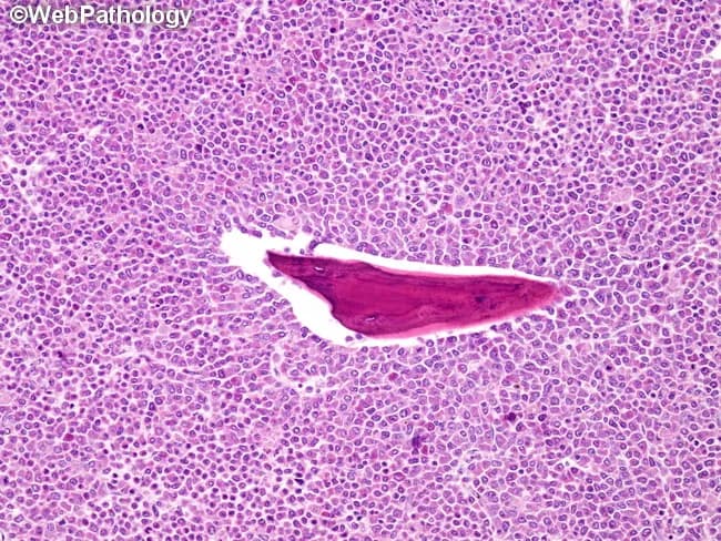 Imaging modality: light microscopy of a hematoxylin and eosin stained bone-tissue section from the femur, obtained in a 65-year-old male with a pathologic fracture. The specimen demonstrates a diffuse, high-cellularity infiltrate composed predominantly of immature myeloid cells, including myeloblasts, promyelocytes, and eosinophilic myelocytes. The tumor occupies the medullary cavity and expands the bony trabeculae with scant extracellular stroma. Morphology shows round to oval cells with high nuclear-to-cytoplasmic ratio, fine chromatin, conspicuous nucleoli, and mitotic activity; occasional cells show eosinophilic cytoplasm consistent with eosinophilic myelocytes. The background marrow is overtaken by neoplastic hematopoietic elements, with little evidence of maturation toward segmented granulocytes. The tissue architecture is diffuse rather than organized into blasts arranged in clusters. The presence of eosinophilic myelocytes supports a myeloid lineage; the pattern is compatible with myeloid sarcoma (granulocytic sarcoma) with predominant blast-rich differentiation. Clinically, this finding indicates an extramedullary myeloid tumor and may be associated with acute myeloid leukemia or myelodysplastic syndromes. Accurate classification (blastic vs immature vs differentiated) informs prognosis and guides systemic therapy, including AML-type chemotherapy, targeted approaches, and bone-targeted strategies. Differential considerations include lymphoma, small round blue cell tumors, and Ewing sarcoma; correlation with peripheral blood and marrow studies is essential for staging and management.