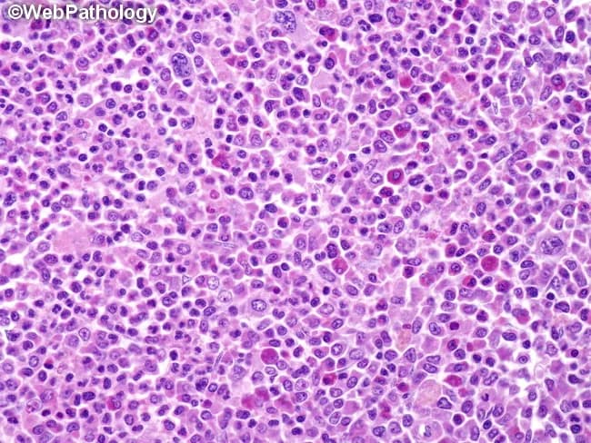 High-power histopathology image obtained from an extramedullary myeloid sarcoma demonstrates sheets of immature myeloid blasts interrupting normal tissue architecture. The smear-like arrangement is evident, with cells distributed in diffuse clusters and occasionally separated by fibrous septa, creating a pale, lace-like stromal pattern. The neoplastic cells are predominantly small to medium-sized with round to oval vesicular nuclei and finely stippled chromatin; nuclear contours are often slightly irregular, and nucleoli may be inconspicuous at this magnification. Cytoplasm is scant to moderate and variably eosinophilic. Occasional differentiated elements are seen, including maturing granulocytic precursors and, less frequently, erythroid and megakaryocytic cells, reflecting partial lineage maturation within the tumor. The cells easiest to recognize are eosinophilic myelocytes with their distinctive orange cytoplasm (as nicely seen in this case). However, they are present only in a small percentage of cases. Immunophenotypic confirmation is typically pursued; the histology alone may resemble diffuse large B-cell lymphoma, necessitating myeloid markers such as MPO, CD34, CD117, and CD43 for accurate classification. Clinical relevance lies in recognizing that granulocytic sarcoma may precede, coincide with, or herald progression to acute myeloid leukemia, influencing staging, prognosis, and therapeutic strategy (AML-type chemotherapy). Correlation with ancillary studies elevates diagnostic confidence and guides urgent management. This image captures key diagnostic features for teaching and reference.