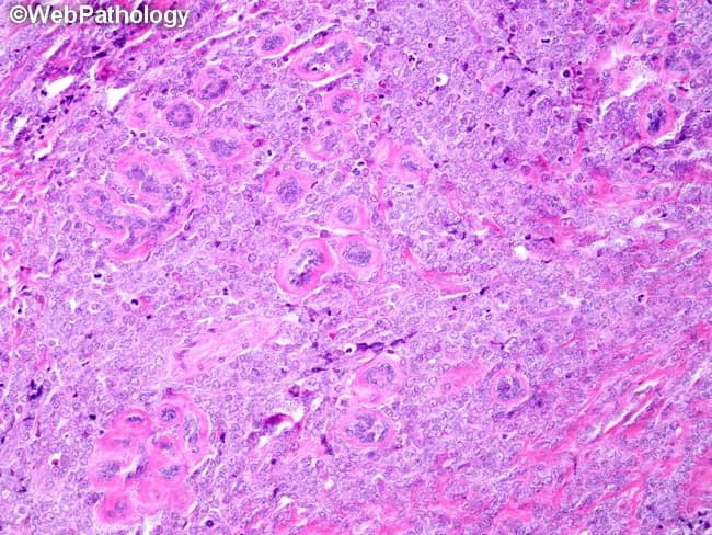 This histopathology image represents a diffuse, high-cellularity mammary lesion consisting of immature myeloid blasts arranged in sheets with effacement of normal breast architecture. On routine H&E staining, tumor cells show medium to large size, scant to moderate cytoplasm, finely dispersed chromatin, and punctate nucleoli. The background may reveal a vascular, inflammatory stroma with little residual glandular differentiation. The finding is pathognomonic for extramedullary myeloid sarcoma (chloroma) and, in the appropriate clinical setting, diagnostic of acute myeloid leukemia. Immunophenotyping would typically reveal myeloid lineage markers; immunocytochemistry can show myeloperoxidase (MPO), CD33, CD13, CD34, CD68, and other Auer rod-associated features in some cases; cytochemical MPO positivity supports diagnosis. Clinically, breast myeloid sarcoma mandates systemic AML-type chemotherapy, not isolated local therapy; prognosis depends on systemic treatment response and risk of extramedullary relapse. Diagnostic significance includes the need for hematologic workup (bone marrow evaluation, peripheral smear) and genetic/cytogenetic/molecular profiling to guide therapy. Differential diagnoses include lymphoblastic lymphoma and metastatic breast carcinoma; multidisciplinary coordination is essential to optimize disease control, monitor for CNS involvement, and implement prophylaxis as indicated. This image emphasizes the importance of recognizing extramedullary AML manifestations in solid organs for timely, systemic treatment.