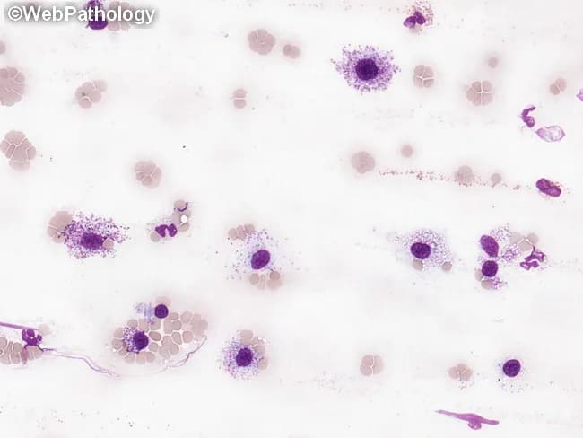 This peripheral blood smear was prepared and stained with Wright-Giemsa and examined by bright-field light microscopy to assess circulating hematopoietic cells in suspected systemic mastocytosis (SM). The smear shows rare, but conspicuous, mast cells with round to polygonal shapes and abundant cytoplasmic granules that impart a deep purple, metachromatic appearance. Nuclei are generally round to ovoid and may be slightly irregular or bilobed in some cells; granules occupy most of the cytoplasm and may obscure nuclear detail. The surrounding leukocytes include eosinophils and neutrophils, and the erythrocyte background is normocytic with occasional anisocytosis. In SM, circulating mast cells are typically infrequent; when they constitute a substantial fraction of leukocytes (≥10%), the finding is highly suggestive of mast cell leukemia (MCL). The image exemplifies an increased mast cell burden consistent with aggressive SM or MCL, often accompanied by cytopenias such as anemia or thrombocytopenia and potential associated hematologic neoplasms (e.g., CMML, MDS/MPN). This morphologic snapshot supports integration with phenotypic assays (CD117/c-KIT), flow cytometry, and molecular testing for KIT mutations, to establish diagnosis, prognostication, and therapeutic planning. Relevant keywords: systemic mastocytosis, mast cell leukemia, circulating mast cells, metachromatic granules, Wright-Giemsa, toluidine blue, KIT D816V, CD117, SM-AHN. This description emphasizes morphology guiding diagnosis appropriately.