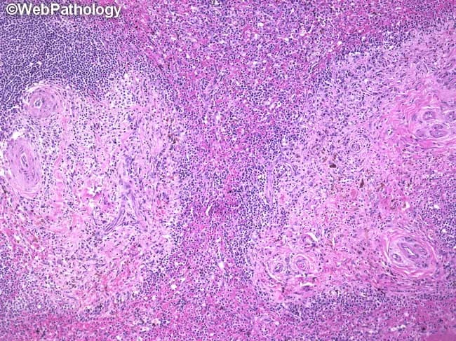 Systemic pathology panel: Histology of a splenectomy specimen from a patient with systemic mastocytosis. Modality: light microscopy on hematoxylin and eosin (H&E) stained sections. Gross features include a thickened splenic capsule with prominent fibrosis and a cut surface showing multiple 1–2 mm nodular foci scattered throughout the parenchyma. Microscopically, these nodules comprise mast cell infiltrates that are spindle-shaped and round, dispersed through both red pulp and white pulp, with a granulomatous appearance. Eosinophils and plasma cells accompany the infiltrate. Immunophenotype aligns with systemic mastocytosis: flow cytometry positive for CD2, CD25, CD117 and tryptase; negative for CD3, CD4, CD20, and CD34. The architectural disruption reflects involvement of the splenic microenvironment, often with hypersplenism and cytopenias as clinical correlates. In this case, patient history includes flushing, dermatologic lesions, diarrhea, hepatosplenomegaly, anemia, and thrombocytopenia; the final diagnosis is systemic mastocytosis with splenic involvement. Radiology is not applicable in this histology image. Clinically, such splenic involvement can be massive in aggressive systemic mastocytosis or systemic mastocytosis with associated hematologic neoplasm. This image illustrates diagnostic clues such as mast cells in fibrotic granulomas within both splenic pulp compartments and provides a reference for differential considerations and therapeutic implications. Useful for education and research instruction purposes.