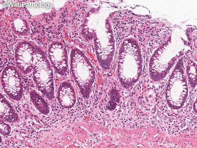 Imaging modality and technique: Light microscopy of a formalin-fixed colon mucosa biopsy (4–5 μm) stained with Hematoxylin and Eosin (H&E). Anatomical site: colorectal mucosa, large intestine, colonic lamina propria with crypts. Visual features: intact goblet cell–rich tubular glands with tall columnar epithelium; crypts preserved; lamina propria shows mild cellular inflammatory infiltrate, composed predominantly of lymphocytes and plasma cells; no active cryptitis, crypt abscess, or mucosal erosions evident. In this section, there is no obvious mast cell infiltrate or mast cell clusters near the muscularis mucosae; thus not diagnostic for GI involvement by systemic mastocytosis on this field. Differential considerations include inflammatory bowel disease patterns (ulcerative colitis or Crohn’s disease) versus reactive mucosal inflammation; other mimickers include infectious colitis and medication-related changes. Diagnostic significance: In SM, GI involvement is typically demonstrated by small compact MC infiltrates in the deep lamina propria near muscularis mucosae; their absence here does not exclude SM if clinical suspicion remains; immunohistochemical confirmation using tryptase, CD117 (c-KIT) staining or flow cytometry on adjacent tissue could identify mast cells. Clinical utility: correlate with flushing and mediator-related GI complaints; guide therapy with antihistamines and mast cell stabilizers; immunohistochemistry for mast cells (tryptase, CD117) may aid diagnosis; this image illustrates SM-related GI histology considerations for pathology and GI practice.