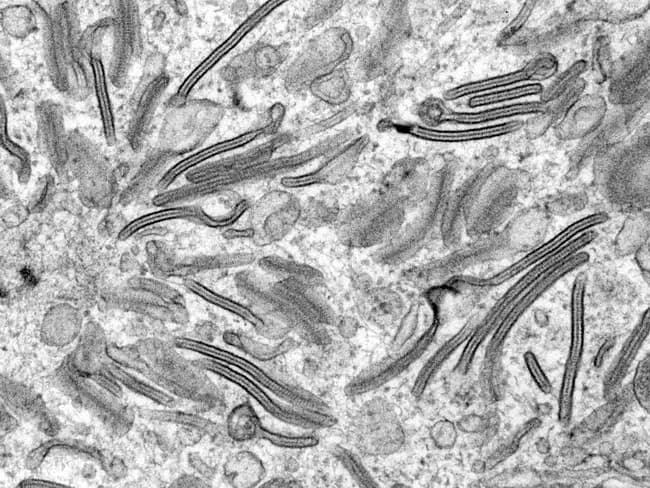 Imaging modality and technique: Transmission Electron Microscopy (TEM); ultrastructural visualization of Birbeck granules within Langerhans cells. Specimen: routine biopsy tissue containing dendritic histiocytes from a suspected Langerhans cell histiocytosis lesion. Location: cutaneous/epidermal/dermal tissue; observed in situ cytoplasmic inclusions. Features: Birbeck granules are zipper-like, pentalaminar rods with a dilated terminal end producing a tennis racket shaped appearance. These cytoplasmic organelles measure approximately 200-400 nm in length and about 33 nm in width. The dilated distal end contains langerin (CD207) and is a hallmark ultrastructural feature of Langerhans cells. Comparative context: Birbeck granules distinguish Langerhans cells from other mononuclear phagocytes on TEM; however, modern diagnostics rely on immunohistochemical markers such as CD1a and CD207 (langerin), making TEM less routinely used today. Pathological significance: the presence of Birbeck granules supports a diagnosis of Langerhans cell histiocytosis when correlated with histology and IHC. Clinical correlation: LCH may present with bone lesions, skin rash, or organ involvement; TEM was historically the gold standard but is now largely supplanted by CD1a and langerin IHC, with ultrastructural confirmation reserved for academic or unresolved cases. Educational utility: illustrates classic ultrastructure of dendritic histiocytes and their diagnostic utility in pathology. This image emphasizes ultrastructural differentiation and context for learners.