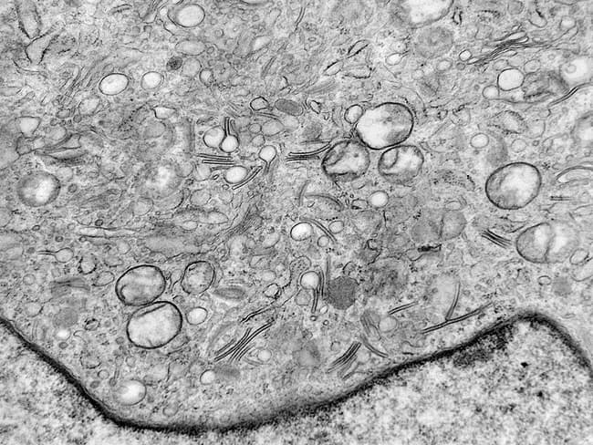 Transmission Electron Microscopy (TEM) image of an epidermal Langerhans cell illustrating Birbeck granules. Birbeck granules are zipper‑like, pentalaminar tubules with a dilated terminus that yields a tennis‑racket appearance; their canonical morphology is highly specific for Langerhans cells. In this specimen, the granules measure approximately 200–400 nanometers in length and about 33 nanometers in width, with a characteristic periodic, curvilinear lattice within the tubule walls. The dilated end often contains structural proteins such as langerin (CD207) and participates in antigen capture and processing. TEM historically served as a gold standard for diagnosing Langerhans cell histiocytosis (LCH) by demonstrating these ultrastructural features; however, modern diagnostic practice relies more on immunohistochemical markers (CD1a and CD207) and molecular tests, making TEM less commonly used. The surrounding cytoplasm shows abundant organelles consistent with active endocytic dendritic cells; cells may exhibit vesicular inclusions and moderate cytoplasmic granularity. This image highlights ultrastructural detail essential for educational purposes and differential diagnosis, particularly in ambiguous cases where immunophenotype is equivocal. Clinically relevant scenarios include suspected LCH in pediatric or adult patients, evaluating skin, bone, or organ involvement, and correlating ultrastructural findings with histology and flow immunophenotyping to confirm diagnosis and guide therapy planning. This image is valuable for teaching.