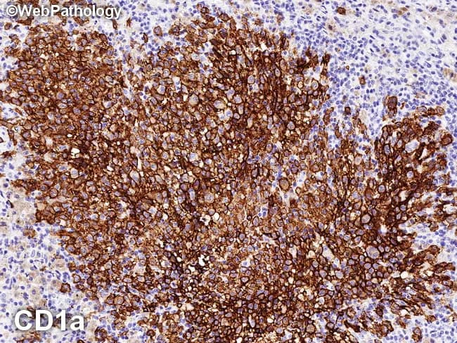 Immunohistochemistry image of pulmonary tissue stained for CD1a demonstrating Langerhans cell histiocytosis. Modality: Immunohistochemistry (IHC) using CD1a primary antibody with DAB chromogen and hematoxylin counterstain. The specimen is lung parenchyma showing a dense cluster of mononuclear dendritic cells with characteristic irregular, reniform (coffee-bean) nuclei surrounded by a background of inflammatory cells. Strong, paranuclear and cytoplasmic CD1a positivity is evident as uniform brown membrane/cytoplasmic labeling of most lesional cells. Langerin (CD207) and S-100 would be co-expressed in the Langerhans cells, though not all panels may be shown in this image. The staining pattern and cellular morphology support the diagnosis of LCH in the pulmonary setting, where Langerhans cells form focal infiltrates and can be associated with smoking-related lung disease. Birbeck granules, while historically demonstrated by electron microscopy, are now replaced by the immunophenotype. This image emphasizes diagnostic specificity of CD1a positivity for identifying Langerhans cells within the alveolar/interstitial compartment. Clinically, pulmonary LCH is frequently linked to adult smokers and may present with nodules or cystic lesions on radiology; histology for CD1a/CD207/S-100 confirms the diagnosis and guides management, including smoking cessation, surveillance, and potential targeted therapies in refractory cases. This panel is essential for diagnostic confirmation in ambiguous clinical-pathological scenarios.
