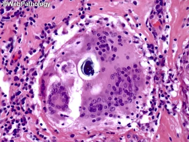 Histopathology image showing a granulomatous lesion composed of epithelioid histiocytes with a surrounding rim of lymphocytes and occasional Langhans-type multinucleated giant cells. Within a giant cell, lamellar inclusions known as Schaumann bodies are evident as concentric rings of protein and mineral material; calcium oxalate crystals may also be present. Asteroid bodies may be seen as stellate inclusions, though they are not required for diagnosis. The granuloma is noncaseating, lacking central necrosis, which favors sarcoidosis over infectious granulomatous processes such as tuberculosis. The tissue architecture shows well-formed granulomas with distinct borders, often adjacent to blood vessels in this section. The image is stained with Hematoxylin and Eosin (H&E), highlighting eosinophilic granulomatous material and basophilic nuclei within giant cells. Clinically, the presence of Schaumann bodies and Langhans giant cells supports a granulomatous inflammatory syndrome but is not pathognomonic for sarcoidosis. Differential considerations include berylliosis, hypersensitivity pneumonitis, fungal or mycobacterial infections, and foreign body reactions. Correlation with chest imaging, serum ACE levels, and clinical features is essential for diagnosis. This slide serves an educational role in recognizing granulomatous histology, giant cell inclusions, and lamellar calcific bodies, informing diagnostic workflows and teaching pathology trainees about sarcoidosis-related granulomatous disease.