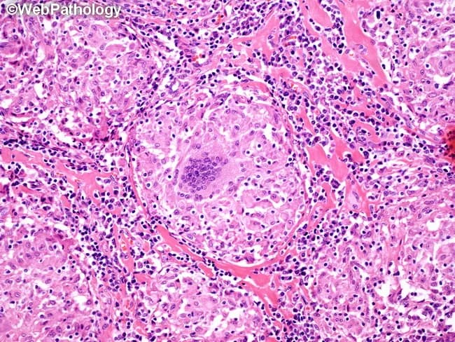 Histopathology via light microscopy of an H&E-stained lymph node biopsy demonstrates a granulomatous inflammatory response characterized by an epithelioid cell nodular formation with a surrounding lymphocytic infiltrate. Within the central core, a multinucleated Langhans-type giant cell is present, displaying nuclei arranged in a horseshoe pattern at the periphery. The granuloma is composed predominantly of well-differentiated epithelioid histiocytes with scant cytoplasm and tight cellular packing, producing a palisaded appearance that integrates with a mildly eosinophilic to translucent extracellular matrix. The surrounding paracortex contains a dense lymphoid crowding with scattered plasma cells and occasional eosinophils, consistent with chronic granulomatous inflammation. In this image, the granuloma lacks conspicuous caseous necrosis, a feature that supports noncaseating granulomatous processes; however, logical caveats apply since granulomas in sarcoidosis can mimic infectious etiologies. The presence of Langhans-type giant cells within nonnecrotizing granulomas is classically associated with sarcoidosis but can be seen in tuberculosis, atypical mycobacterial infections, fungal infections, berylliosis, and other granulomatous diseases. Additional diagnostic workup would include acid-fast bacilli staining and fungal stains, microbial cultures, and clinical correlation. Recognizing this histologic pattern guides differential diagnosis toward sarcoid-type granulomatous lymphadenitis and informs subsequent clinical management and exclusion of granulomatous infections. Correlation with imaging and laboratory data essential.