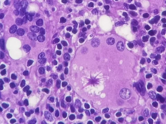 Histology of a silicone lymph node biopsy examined by light microscopy using Hematoxylin and Eosin staining. The specimen shows a granulomatous lymphadenopathy with a prominent giant cell reaction. Within the cytoplasm of epithelioid and multinucleated giant cells sits a large, eosinophilic asteroid body characterized by a centralized core and radiating, star‑like filamentous arms. The asteroid inclusions stain intensely with hematoxylin, and their radiating processes extend toward surrounding macrophages. Surrounding tissue displays silicone-induced foreign body granulomas with vacuolated spaces and surrounding chronic inflammatory cells. The asteroid body itself is a distinctive cytoplasmic inclusion thought to contain complex lipoproteins and mineral components such as calcium, phosphorus, silicon, and aluminum. This morphological finding is most classically described in silicone lymphadenopathy but can also be observed in sarcoidosis and other granulomatous diseases. Clinically, asteroid bodies support a silicone exposure–related process when correlated with implant history or imaging, but their presence is not pathognomonic. Differential diagnosis includes sarcoidosis, foreign body granulomatosis, mycobacterial, and fungal granulomatous infections. The observation aids diagnostic stratification, guides further testing for systemic granulomatous disease, and informs patient counseling regarding implant-associated lymphadenopathy and granulomatous inflammation. This description emphasizes asteroid body recognition as a valuable histopathologic clue in implant-era lymphadenopathy for clinical correlation.