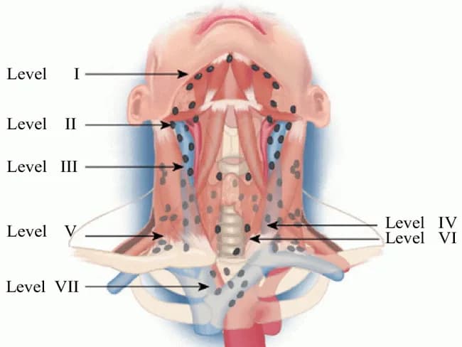 An educational anatomical illustration of cervical lymph node drainage and metastasis patterns in thyroid cancer. The diagram labels lymph node levels I through VII, with sublevel III and II branches, and highlights the first echelon associations near the thyroid: paralaryngeal, paratracheal, and prelaryngeal nodes (level VI). It also shows progressively lower levels (I, IIA, IIB, III, IV, V) and the upper mediastinal level VII; retropharyngeal involvement may occur in extensive lateral disease. The illustration emphasizes bilateral cervical metastasis is common in thyroid carcinomas and notes the absence of a minimum lymph node requirement for sampling in thyroid cancer procedures. Visual cues indicate regional spread to level I in rare cases and more frequent involvement of level VII in mediastinal extension. The image serves as a teaching tool for surgical planning, preoperative radiologic assessment, and oncologic staging. It supports interpretation of neck dissection maps (levels I-VII) and helps correlate imaging findings with operative strategy. Clinically, this schematic is relevant to endocrinology, surgical oncology, head-and-neck radiology, and pathology education. Keywords include thyroid cancer, differentiated thyroid carcinoma, cervical nodal metastasis, lymph node map, neck levels, bilateral involvement, level VI, level VII, retropharyngeal nodes, dissection planning, and N-staging for clinical research and education worldwide.
