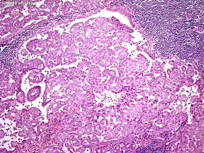 This is a light microscopy histopathology image of a human kidney biopsy stained with Hematoxylin and Eosin. The specimen comprises renal cortex with glomeruli and surrounding tubulointerstitial elements. The glomeruli appear variably cellular with focal expansion of the mesangial matrix, while the surrounding interstitium shows a mixed inflammatory infiltrate concentrated around tubular segments. Tubules exhibit epithelial flattening and mild tubular dilation with rare proteinaceous casts, and there is edema in the interstitial stroma. Vascular structures are not prominently featured in this field. Overall, there is evidence of tubulointerstitial inflammation with relative sparing of the glomerular capillary loops, a pattern that can be seen in acute interstitial nephritis or immune-mediated tubulointerstitial disease. No overt crescent formation or global glomerular necrosis is readily evident in this field. The density and distribution of inflammatory cells vary between areas, suggesting patchy involvement. The image highlights the interface between inflamed interstitium and nephron units, with preserved glomerular architecture in some regions and mild glomerular hypercellularity in others. Clinically, such histology supports inflammatory renal disease, guides differential diagnosis toward tubulointerstitial processes, and would prompt correlation with exposure history, complement levels, serologies, and urinalysis for diagnostic refinement and therapeutic decisions.