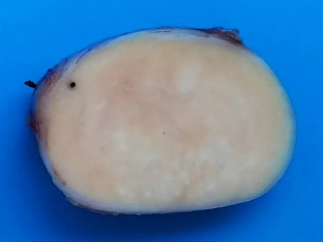 Gross pathology photograph of a dissected lymph node presented as a cross-sectional specimen. The nodal mass is markedly enlarged, with a white-tan to pale cream color and a uniform, homogenous cut surface that is solid in firmness. The capsule appears intact and there is no obvious central necrosis, hemorrhage, or calcification on the visible face. This macroscopic appearance is compatible with massive nodal enlargement often described in Rosai-Dorfman disease, a benign, self-limiting histiocytic disorder, but definitive diagnosis requires microscopic histology and immunohistochemistry. The image emphasizes gross features rather than tissue architecture: a large, well-demarcated lymph node with an even texture and a lack of gross necrotic change. Clinically, Rosai-Dorfman disease commonly presents with fever and weight loss and can involve multiple lymph node groups as well as extranodal sites such as skin or central nervous system; however, the current image depicts only a nodal specimen. The gross image is valuable for educational purposes, illustrating differential considerations in lymphadenopathy, including infectious, inflammatory, and malignant etiologies. In practice, gross assessment guides sampling strategy for histopathology, guiding subsequent techniques such as light microscopy, immunostaining for S-100 and CD68, and emperipolesis demonstration. This image supports gross pathology teaching, case-based discussion, and correlation with clinical presentation.