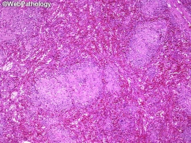 This is a photomicrograph of a splenic parenchyma section from a splenectomy specimen, prepared for light microscopy and stained with hematoxylin and eosin. The specimen shows multiple subcentimeter nodules within the splenic parenchyma, with well-formed, non-caseating granulomas composed of tightly arranged epithelioid macrophages and multinucleated giant cells surrounded by a lymphocytic rim. The granulomas lack central necrosis, which, along with histiocytic microarchitecture, is highly suggestive of granulomatous inflammation due to Toxoplasma gondii infection. Serologic tests confirmed toxoplasmosis in this patient, correlating with disseminated disease or focal splenic involvement associated with lymphadenopathy and splenomegaly. In the spleen, toxoplasmosis can produce discrete nodules or focal granulomatous lesions that may mimic lymphoma or other granulomatous diseases on imaging or gross examination. Key differential diagnoses include sarcoidosis, fungal infections such as histoplasmosis, mycobacterial infections, and other parasitic infestations; clinical correlation with serology and immune status is essential. This image is relevant for teaching granulomatous splenitis due to toxoplasmosis, assessing granuloma morphology, distinguishing non-caseating from caseating granulomas, and correlating histology with systemic infection. Appropriate clinical scenarios include immunocompromised patients with fever, cytopenias, or organomegaly and routine pathology review in splenectomy specimens. This image exemplifies infectious granulomatous disease companion to serology and morphology in clinical practice.