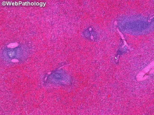 Histopathology of splenic tissue from a patient with autoimmune hemolytic anemia. Imaging modality: light microscopy of an H&E-stained section of spleen; micrograph shows gross splenomegaly with a deep red cut surface. The microscopic fields reveal marked congestion of the red pulp with dilated sinusoids and widened splenic cords (Billroth cords) within the red pulp. White pulp is not markedly expanded. The architecture appears largely preserved apart from venous congestion; erythrocyte pooling produces a hyperemic, reddish appearance. There is no evident infarction or necrosis in the depicted fields. The prominent vascular congestion reflects hypersplenism and increased sequestration/destruction of red cells in the setting of autoimmune hemolytic anemia. Pathologic findings are dominated by red pulp hyperemia and congested sinusoids, consistent with congestive splenomegaly. Clinically, this morphology correlates with ongoing hemolysis, anemia, and potential hypersplenism; splenic pooling can contribute to decreased circulating red cells and altered retic count. Differential considerations include portal hypertension-related splenomegaly, infectious mononucleosis, or other causes of splenic congestion, but the clinical context (AIHA) supports splenic vascular congestion as the primary lesion. This image is relevant for educational discussions of splenic pathology, hypersplenism, AIHA-associated splenomegaly, and examples of congestive splenic changes. This description supports radiologists and pathologists in correlating clinical data.