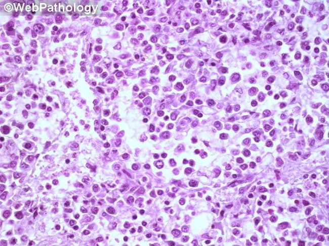 Imaging modality: light microscopy of a hematopathology slide from a bone marrow aspirate smear. Stain: Hematoxylin and Eosin (H&E). Magnification: high-power field (~400x total; 40x objective with 10x ocular). Anatomical location: bone marrow within the medullary cavity (hematopoietic tissue). Visual features: sheets of immature blasts with high nuclear-to-cytoplasmic ratio, round to oval nuclei, fine chromatin, prominent nucleoli, and scant basophilic cytoplasm; increased cellularity with near-complete effacement of normal hematopoiesis; occasional mitotic figures; minimal cytoplasmic granularity; sparse residual neutrophils, erythroid precursors, and megakaryocytes. Pathologic interpretation: diffuse marrow infiltration by blasts, consistent with an acute leukemia until immunophenotyping and genetic studies delineate subtype. Diagnostic significance: morphologic hallmark of an acute hematologic malignancy; requires ancillary tests (flow cytometry, immunohistochemistry, cytogenetics/molecular studies) for lineage classification (myeloid vs lymphoid), prognosis, and treatment planning. Differential considerations: ALL (acute lymphoblastic leukemia), AML (acute myeloid leukemia), lymphoblastic lymphoma with marrow involvement, myelodysplastic syndrome with excess blasts, or nonhematopoietic marrow infiltration. Clinical correlation: commonly presents with cytopenias, fatigue, infections, and bleeding; pediatric ALL vs adult AML guidance; urgent hematology-oncology workup is indicated. Educational use: foundational blast morphology recognition, marrow infiltration patterns, and the need for confirmatory immunophenotyping. This image is valuable for training in blast morphology, differential diagnosis, and education in hematopathology.