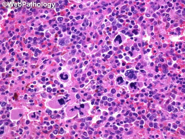 High-magnification brightfield micrograph of a human bone marrow aspirate smear stained with Hematoxylin and Eosin, demonstrating dysplastic megakaryocytes in a hematopoietic background. The megakaryocytes exhibit atypical nuclear morphology, including multinucleation, irregular lobulation, and nuclear fragmentation, with variable cytoplasmic basophilia. Background cellularity shows concurrent dyserythropoiesis and dysplastic myeloid precursors consistent with a myelodysplastic spectrum. Overall architecture may be hypercellular or variably cellular, with scattered normal hematopoietic elements interspersed among abnormal cells. Features are most prominent in the megakaryocytic lineage, where dysplasia is a salient hallmark. The image illustrates morphologic criteria that support a diagnosis in the context of possible progression toward acute leukemia, and should be correlated with peripheral blood counts, marrow blast percentage, cytogenetic and molecular studies. Clinically, such dysplastic megakaryocytes are associated with cytopenias and splenomegaly, and approximately a fifth of patients with related myelodysplastic/myeloproliferative conditions progress to acute myeloid leukemia. This representation is valuable for educational, diagnostic, and research purposes, particularly in studies of megakaryocytic dysplasia, MDS/AML continuum, prognostication, and therapeutic planning focused on palliation and cytopenia management. Careful documentation of features and context enhances reproducibility, supports standardized reporting, and facilitates cross-institutional data sharing for outcome studies and biomarker-driven clinical trials.