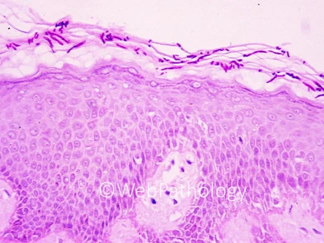 This is a skin histopathology specimen stained with Periodic Acid-Schiff (PAS), imaged under light microscopy. The biopsy shows epidermal and superficial dermal compartments of cutaneous tissue with characteristic fungal elements. PAS positivity highlights both yeast forms and pseudohyphae within the stratum corneum and epidermis, consistent with cutaneous candidiasis. Yeasts appear as small to oval budding cells; pseudohyphae are elongated, branching, and may extend through the keratinocyte layers. The epidermis may demonstrate mild acanthosis with preserved overall architecture; scattered neutrophilic microabscesses can be present in the epidermis or papillary dermis as part of the inflammatory response. These histologic features, in combination with PAS staining, solidify the diagnosis of Candida species infection of the skin. Clinical significance: recognition of intraepidermal yeast and pseudohyphae with PAS staining supports targeted antifungal therapy (topical azoles or oral agents in extensive disease) and prompts assessment for predisposing factors such as moisture, obesity, diabetes, immunosuppression, or antibiotic exposure. Differential considerations include dermatophyte infections (dermatophyte hyphae), Malassezia spp., and other yeasts; however, the presence of pseudohyphae favors Candida. This image is valuable for dermatopathology education, fungal biology research, and diagnostic pathology training, illustrating canonical histologic hallmarks of cutaneous candidiasis and the utility of PAS for fungal visualization.
