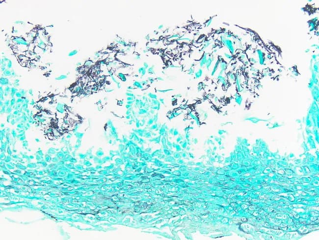 Imaging modality: histopathology with light microscopy of a Gomori methenamine silver (GMS) stained esophageal mucosal biopsy. Primary anatomic site: esophagus, specifically the stratified squamous epithelium of the distal to mid-esophagus with involvement of the lamina propria. The specimen demonstrates surface and intraepithelial fungal elements highlighted by GMS as dark, threadlike structures consisting of yeast forms and slender pseudohyphae, with occasional budding yeasts. The mucosal architecture shows preserved epithelium with focal inflammatory infiltrates and minimal necrosis in this field. Notable features include abundant fungal pseudohyphae and yeast forms within the epithelium and superficial lamina propria, confirming candida infection; the GMS stain provides high-contrast visualization against a light background. Pathological diagnosis: Candida esophagitis with fungal hyphae-like elements and budding yeast consistent with Candida spp., most commonly Candida albicans. Diagnostic significance: histologic confirmation supports clinical odynophagia and dysphagia, particularly in immunocompromised patients, HIV/AIDS, post-therapy states, or post-antibiotic exposure. Differential considerations include other fungal infections (Histoplasma, Cryptococcus) and non-infectious mimics; differentiation relies on morphologic patterns and special stains. Clinical relevance: informs selection and duration of antifungal therapy (e.g., fluconazole, echinocandins) and monitoring response; serves as a teaching example for gastroenterology, pathology, and infectious disease training. This image is educational for diagnostics and differential diagnosis.
