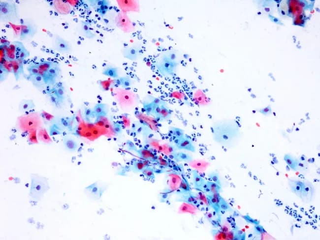 Conventional cervical cytology Pap smear demonstrates opportunistic yeast colonization consistent with Candida species. The primary cellular component comprises intermediate and superficial squamous cells within clusters, with abundant oval budding yeast forms measuring approximately 1–2 μm. Prominent pseudohyphae extend from yeast structures and appear eosinophilic with uneven staining on the cytology smear. A robust neutrophilic inflammatory background accompanies the fungal elements, reflecting active fungal infection and acute inflammatory response. The yeast forms are small, round to ovoid, with smooth contours and budding patterns; the accompanying pseudohyphae appear as elongated filamentous structures, often terminating in small buds. The appearance is diagnostic of Candida infection in vaginal/cervical cytology and can be seen in vulvovaginal candidiasis, cervicitis, or secondary colonization in patients with recent antibiotic exposure or immunocompromise. Consider differential diagnoses that can mimic yeast elements on Pap stain include other yeasts such as Saccharomyces and nonpathogenic contaminants, but the presence of true pseudohyphae and budding yeast strongly favors Candida. Clinically, these findings should prompt correlation with symptoms such as pruritus, discharge, and risk factors like diabetes mellitus, pregnancy, or immune suppression, and guide antifungal therapy decisions. Follow-up cytology or microbiology cultures may be used to determine species.
