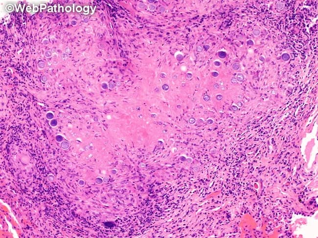 Imaging modality and technique: Histology using light microscopy; routine Hematoxylin and Eosin (H&E) stained paraffin section of lung parenchyma. In this pulmonary coccidioidomycosis specimen, tissue shows granulomatous inflammation with both necrotizing and non-necrotizing granulomas embedded in a background of mixed inflammatory cells, including epithelioid histiocytes, neutrophils, eosinophils, lymphocytes, plasma cells, and multinucleated giant cells. The defining fungal morphology comprises spherules of Coccidioides spp., present as mature and immature forms. Mature spherules are thick-walled, doubly refractile spheres measuring approximately 60–100 μm in diameter and containing numerous endospores 2–5 μm in diameter. Immature spherules are smaller and may be visible as the infection progresses. In rare circumstances, mycelial forms may be observed interspersed with bronchopulmonary fistulas or aerated cavitary lesions. Fungal elements localize within granulomas and interstitial spaces, with occasional minor invasion of adjacent tissue. Clinically, the presence of spherules with endospores in lung tissue is diagnostic of pulmonary coccidioidomycosis and guides antifungal therapy, prognosis, and infection control. Differential considerations include Histoplasma, Aspergillus, Blastomyces, Cryptococcus, and other fungal pathogens; correlation with culture, serology, and imaging is recommended for comprehensive management. This image is educational for pathology training and research on endemic mycoses and granulomatous lung disease, and case discussion for learners everywhere.