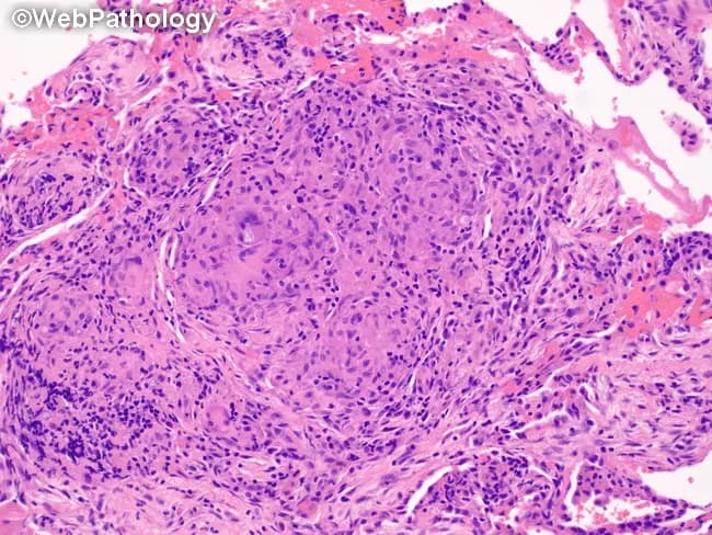 Pulmonary tissue from a wedge resection stained with Hematoxylin and Eosin, analyzed by brightfield light microscopy. The specimen shows robust granulomatous inflammation within the lung parenchyma consistent with a granulomatous infectious process. Nodular aggregates of epithelioid histiocytes are surrounded by a rim of lymphocytes and scattered plasma cells; multinucleated Langhans-type giant cells are present, producing a palisading appearance. The granulomas appear well circumscribed within the interstitium and may encroach upon adjacent alveolar spaces. Central necrosis is variably present and not conspicuously predominant in this field, a feature compatible with coccidioidal granulomatous reaction (coccidioidomycosis) that may display BCG-like granulomas in tissue specimens. The background alveolar architecture is preserved in portions, with mild interstitial inflammation and occasional eosinophils. Although fungal organisms are not definitively visualized in this image, the histology is compatible with fungal infection of the lung in the clinical context of pulmonary coccidioidomycosis, potentially associated with chronic granulomatous response. This image emphasizes characteristic granuloma morphology useful for differential diagnosis from mycobacterial tuberculosis or sarcoidosis, and provides histopathologic confirmation to guide clinical management, including antifungal therapy decisions and serology correlation. It is suitable for education on pulmonary granulomatous disease and wedge resection pathology.