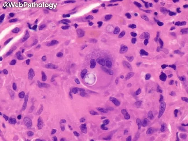 Pulmonary tissue section (lung biopsy) stained with hematoxylin and eosin, examined under brightfield light microscopy at high magnification. The specimen shows a well-formed epithelioid granulomatous reaction within the pulmonary parenchyma, composed of aggregates of epithelioid histiocytes and multinucleated giant cells encircling a developing Coccidioides spherule. An immature, thick-walled spherule is evident within a giant cell, containing sparse endospores. Surrounding lymphocytes and occasional plasma cells contribute to the granulomatous milieu. The background is pink extracellular matrix with scattered alveolar spaces; no overt necrosis is required; note the absence of septate hyphae on H&E. The image epitomizes granulomatous inflammation seen in pulmonary coccidioidomycosis, a fungal disease caused by Coccidioides immitis/posadasii encountered in endemic regions. The spherule's immature stage (BCG-like morphology) is diagnostic in the appropriate clinical context, distinguishing it from other fungal infections such as histoplasmosis or blastomycosis. Clinically, this histology supports a fungal etiology in a patient with respiratory symptoms, fever, and relevant exposure history. Diagnostic significance includes visualizing the fungal spherule within macrophages; differential diagnoses include TB, sarcoidosis, granulomatous pneumonia. Antifungal therapy planning may follow. This image conveys critical features for pathology teaching, endoscopy-guided biopsy interpretation, and research into host-pathogen interactions in endemic mycoses, supporting labeling and targeted antifungal management.