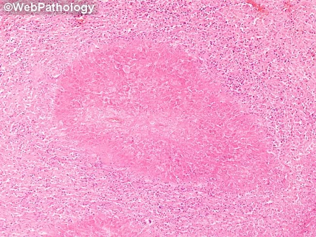 This is a low-magnification brightfield histology image of a tissue section stained with Hematoxylin and Eosin (H&E). The specimen shows granulomatous inflammation with aggregates of epithelioid macrophages forming a rounded granuloma, often with multinucleated giant cells, surrounded by a lymphocytic cuff. The central focus is well circumscribed within native parenchyma, suggesting a chronic, organized immune response to a persistent antigen. Necrosis is not clearly evident at this magnification, though subtle caseation cannot be excluded. Morphology is compatible with tuberculoid or non-caseating granulomas, and infectious versus noninfectious etiologies must be distinguished with ancillary studies. This pattern can occur in lymph nodes or solid organs and prompts a differential that includes tuberculous lymphadenitis, sarcoidosis, fungal granulomatous infections (Histoplasma, Coccidioides), and foreign-body reaction. Clinically, recognition of granulomas guides testing: acid-fast bacilli staining (Ziehl-Neelsen), fungal stains (GMS/PAS), cultures, PCR panels, and radiologic correlation. The image is educational for medical trainees, illustrating granuloma architecture, macrophage differentiation, and the spectrum of chronic inflammatory responses. Educational context.