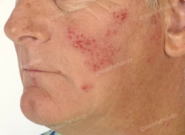 Clinical photography of recurrent herpes simplex virus infection with perioral facial involvement. The image depicts grouped vesicles on an erythematous base positioned around the mouth and adjacent cheek, with focal erosions and crusting consistent with an active HSV-1 reactivation in the perioral distribution. Lesions are small to medium in size, discrete to coalescing, fluid-filled in the vesicular stage, then rupturing to form shallow erosions that crust as they heal. The surrounding skin shows mild edema and diffuse erythema; no purulent discharge or satellite lesions are evident. The left perioral region is the predominant site; this is a common clinical pattern, often precipitated by sun exposure, stress, or viral reactivation. The appearance is classic for herpes labialis variants, though HSV-2 less commonly affects this region. In this context, diagnosis is largely clinical, supported by morphology of grouped vesicles on an erythematous base and characteristic crusting. Differential considerations include impetigo, contact dermatitis, eczema herpeticum, and varicella-zoster in atypical presentations; confirmation can be obtained by PCR or viral culture if needed. Clinically, this presentation guides antiviral therapy (acyclovir, valacyclovir) and symptomatic care; patient counseling on contagion reduction and recurrences is essential. This image is suitable for educational demonstrations of herpes simplex skin lesions and for comparison studies of lesion evolution over time.