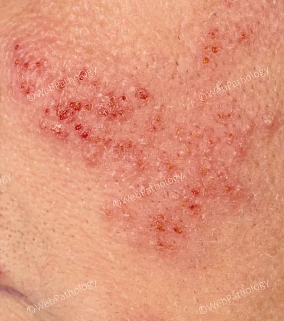 This dermatologic image shows a perioral, facial eruption consistent with recurrent herpes simplex virus infection (HSV-1). The modality is a close‑up clinical photograph under standard white light to capture surface morphology. The perioral skin demonstrates clustered, vesicular lesions evolving on an erythematous base, with shallow erosions and crusting at multiple discrete sites. The vesicles are small to medium in size, often grouped in crops, with clear or hemorrhagic fluid content and surrounding mild edema. The distribution is localized to the perioral region and adjacent cheek, with a frontal facial view that emphasizes symmetry and lesion layering. The lesions reflect the reactivation pattern of HSV, showing papulovesicular to vesicular stages with crusted crusts as they heal. Clinically, these findings correspond to HSV-1 reactivation rather than varicella or other vesiculobullous dermatoses, though differential diagnoses include impetigo, eczema herpeticum, contact dermatitis, or herpes zoster in atypical locations. The image highlights characteristic features such as grouped vesicles on an erythematous base, crusted fissures, and superficial erosions, which inform antiviral therapy decisions and patient counseling regarding contagion. This representation is valuable for education, differential diagnosis training, and clinical reference in dermatology, primary care, and infectious disease contexts.