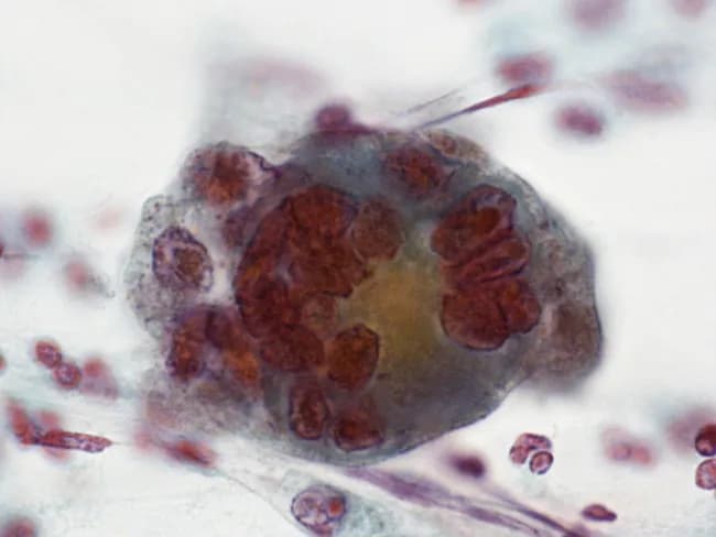 Imaging modality: Conventional cervical cytology (Pap smear) analyzed by light microscopy after Papanicolaou staining. Primary subject: an HSV-induced cytopathic change in cervical squamous epithelium, demonstrated as a multinucleated giant cell with characteristic intranuclear inclusions. Anatomical localization: cervix, transformation zone, squamous epithelium of the lower genital tract. Visual features: a large, rounded cell with abundant cytoplasm, multiple molded nuclei, marginated chromatin, and dense eosinophilic intranuclear inclusions (Cowdry type A). A perinuclear halo and nuclear molding are evident; nuclei tend to crowd together but do not fully overlap. Background typically contains neutrophils or inflammatory cells. Staining accentuates the eosinophilic nuclear inclusions and the halo, enabling recognition of HSV cytopathic effect. Pathological interpretation: cytopathic effects consistent with active herpes simplex virus infection of cervical epithelium (HSV cervicitis). Diagnostic significance: supports clinical suspicion of herpetic cervicitis; guides antiviral therapy and infection control; may prompt confirmatory testing (HSV PCR or viral culture). Differential considerations: cytomegalovirus infection (owl's eye inclusions) can mimic in some respects but shows solitary cells with distinct intranuclear inclusions; koilocytes from HPV are different. Clinical correlation: correlate with symptoms (dysuria, vaginal discharge, genital ulcers) and pregnancy status. Educational relevance: classic cytology example of HSV infection on Pap smear. Reproducible educational reference material.