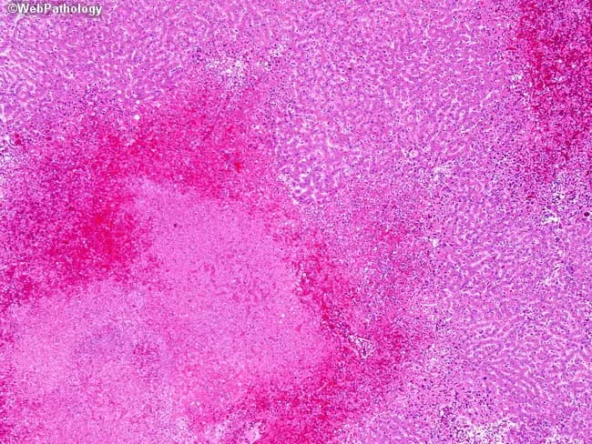 Imaging modality: not relevant; histopathology: Hematoxylin and eosin (H&E) stained liver biopsy. Anatomical location: hepatic parenchyma of the liver, particularly lobular hepatocytes. Visual features: irregular confluent zones of coagulative necrosis with surrounding hemorrhage, producing mottled, pale-to-roseate subcapsular and midzonal areas; the necrotic zones are often well-demarcated from intact parenchyma. Inflammation is disproportionately mild relative to the extent of necrosis, with sparse portal and lobular inflammatory cells. Viral cytopathic effects may be evident as eosinophilic intranuclear inclusions (Cowdry type A) within hepatocytes and occasional multinucleated syncytial cells. The tissue architecture shows disruption of normal hepatic cords, with sinusoidal congestion and hemorrhagic foci. Clinically, these changes reflect fulminant or subfulminant herpes simplex virus hepatitis, a high-mortality entity that can occur in immunocompromised hosts or during disseminated infection. Diagnostic relevance: histology supports HSV in the differential when HSV-specific testing (PCR, immunostaining) confirms viral etiology; the pattern helps distinguish from other viral hepatitides and drug-induced liver injury. Documentation of this pattern informs antiviral management (acyclovir/valacyclovir) and urgent clinical correlation for rapid treatment. Educational use: this image illustrates classic patchy necrosis with hemorrhage and minimal inflammation, aiding histopathology teaching, differential diagnosis, and correlating clinicopathologic findings. Correlation with serology and HSV DNA testing enhances diagnostic confidence significantly.