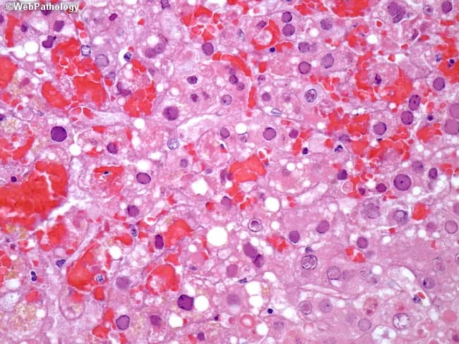 Histology, bright-field light micrographs of liver tissue (liver biopsy) stained with Hematoxylin and Eosin (H&E). The specimen shows hepatic parenchyma with focal to confluent zones of coagulative necrosis within liver lobules, often surrounding viable hepatocytes. Viral cytopathic effects are evident in adjacent cells, including intranuclear inclusions with surrounding clear halos and peripheral chromatin margination producing ground-glass appearing nuclei. Eosinophilic Cowdry type A inclusions or basophilic Cowdry type B inclusions may be present, reflecting HSV-induced nuclear changes. Additional evidence includes scattered enlarged hepatocytes with faint cytoplasmic eosinophilia and occasional cytoplasmic vacuolization; viral particles can be identified in hepatocytes by higher-magnification views (and are detectable with corroborating immunostains). Immunohistochemistry or in situ hybridization can help confirm HSV and exclude other viruses such as CMV, which would display Owl's eye inclusions. The overall pattern is necroinflammation with predominance in periportal to midzonal regions and disruption of normal lobular architecture. Diagnostic significance lies in the combination of characteristic nuclear inclusions, ground-glass nuclei, and necrotizing hepatitis, especially in immunocompromised patients or those with fulminant disease. Clinically, HSV hepatitis requires prompt antiviral therapy and correlation with serology and clinical presentation. Early detection guides antiviral therapy decisions.
