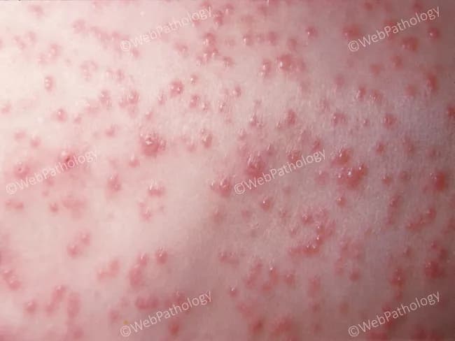 Clinical photography of cutaneous disease. High-resolution macro close-up image of a generalized vesicular rash on the trunk, compatible with Varicella (chickenpox) due to varicella-zoster virus (HHV-3). Anatomical context: integumentary system; skin of the torso (trunk) observed in frontal/anterior view. Visual features: multiple small vesicles (approximately 2-5 mm) containing clear fluid, arranged in crops, at various stages of evolution from vesicles to crusts. Surrounding erythematous halos are common; some lesions appear confluent in areas of diffuse rash. The distribution is trunk-predominant with involvement of the chest and abdomen, often sparing the limbs early in disease; lesions show centripetal dissemination. Classic morphology includes dew drops on a rose petal appearance with vesicles arising on an erythematous base, thin-walled and fragile, possibly eroded by scratching. Pathology: clinical diagnosis supported by history of fever and exposure; virologic confirmation (PCR or DFA) can be used. Diagnostic significance: characteristic vesicular-papular stage lesions in crops establish Varicella diagnosis; differential includes disseminated herpes simplex, hand-foot-mouth disease, disseminated zoster in adults, post-varicella rash. Clinical correlation: consider varicella vaccination status, age, pregnancy status, and risk of bacterial superinfection; contagious during vesicular phase; antiviral therapy indicated for high-risk patients. This image serves as an educational reference for dermatology training and research.