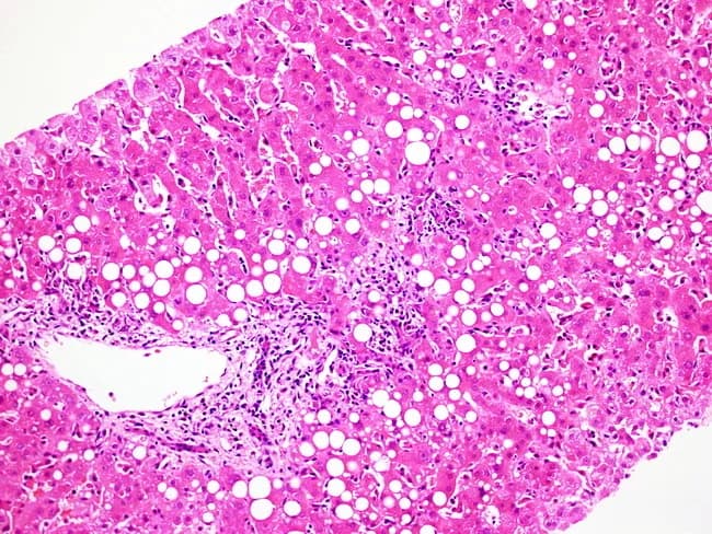 Light microscopy of a liver biopsy stained with Hematoxylin and Eosin demonstrates hepatic parenchymal fatty change with preserved lobular architecture. Numerous large lipid droplets occupy hepatocyte cytoplasm, producing clear vacuoles that give a characteristic macrovesicular steatosis appearance. Scattered hepatocytes exhibit mild ballooning degeneration, reflecting cellular stress. A modest inflammatory infiltrate is present in select portal tracts and within sinusoids, consistent with low-grade inflammation. Kupffer cells appear mildly enlarged, in keeping with portal-sinusoidal immune activation. No bridging necrosis, significant cholestasis, or overt lobular disarray is evident in this field. The pattern is most compatible with fatty liver injury but can be seen with metabolic syndrome, obesity, excessive alcohol intake, or drug/toxin exposure. In the setting of infectious mononucleosis from Epstein-Barr virus, hepatic involvement is common but usually subclinical; histology can show portal and sinusoidal lymphocytic infiltrates with rare atypical lymphocytes, though steatosis is not a defining feature. Therefore, correlation with serology and clinical history is essential for etiologic assignment. This image is a useful teaching reference for recognizing steatosis on liver biopsy, distinguishing fat-laden hepatocytes from inflammatory nodular processes, and framing the differential diagnosis of viral hepatitis versus fatty liver disease in hepatology, pathology, and medical education.