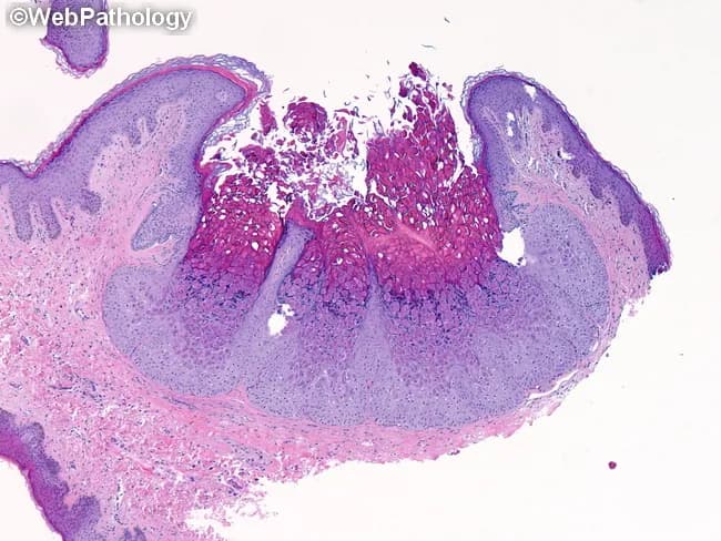 This image depicts a classic Molluscum contagiosum histopathology specimen from a cutaneous lesion examined under brightfield microscopy. Modality used: Light microscopy with Hematoxylin and Eosin staining, enabling visualization of epidermal architecture and cytoplasmic inclusions. Anatomical context: human skin, with an endophytic, cup-shaped, lobulated epidermal proliferation projecting into the dermis and producing a central depression. Morphology: well-circumscribed pseudotumor of thickened squamous epithelium displaying pronounced acanthosis and a central crater, at the edge of hyperplastic epithelium transitioning toward the lesion center. Cytopathic changes: numerous large intracytoplasmic molluscum bodies within keratinocytes of the basal to suprabasal layers; inclusions progress from eosinophilic early to basophilic with maturation and exert compressive effect on the nucleus. The viral inclusions impart a pale halo around nuclei and induce lobular rearrangement of the epithelium. Pathology significance: the presence of molluscum bodies and cup-shaped architecture is highly characteristic and often diagnostic of molluscum contagiosum; aids in distinguishing from verruca vulgaris and other epidermal proliferations. Clinically relevant contexts: pediatric skin lesions; immunosuppressed patients; sexually transmitted infections in adults; offers diagnostic confirmation and guides management (curettage, cryotherapy). Potential diagnostic use: histopathologic confirmation when clinical suspicion is uncertain; correlates with surface lesion appearance (umbilicated papule).