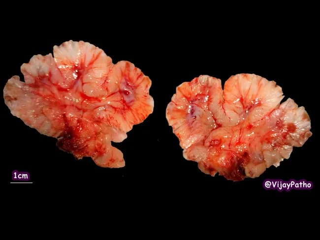 Gross pathology photograph of a bisected genital condyloma acuminatum lesion, showing a soft, fleshy exophytic mass with cauliflower-like papillary architecture. The specimen comprises two symmetrical halves laid side-by-side against a dark background; each fragment measures approximately 1–2 cm in greatest dimension as suggested by a 1 cm scale bar. The surface is pink-tan with irregular, frond-like projections and subtle keratotic grooves. The cut surfaces reveal a fibrous to loosely arranged stroma and thickened epidermis with pronounced papillary infoldings. The lesions are consistent with condyloma acuminatum, most commonly HPV types 6 and 11; they arise on mucocutaneous genital skin including corona of glans, urethral meatus, fossa navicularis, penile shaft, and scrotal skin; similar lesions may occur in vulvar region and perineum. In males, lesions may extend proximally toward the urethra and bladder in extensive disease; symptoms can include itching, bleeding, pain; sexual transmission risk is high; co-infection with other STIs is possible; recurrence is common after treatment. This image highlights the characteristic wart-like architecture: soft, friable, papillary projections with a cauliflower appearance. Understanding gross morphology aids clinical diagnosis and guides subsequent histopathologic confirmation and treatment planning (cryotherapy, topical agents, surgical excision).