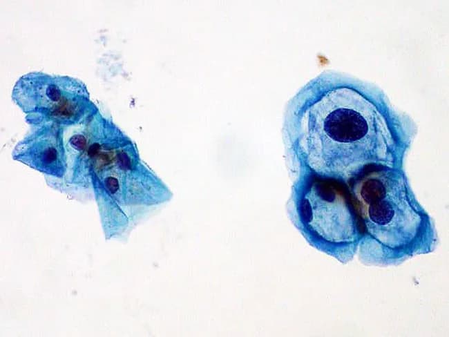 This is a cytology preparation of a cervical sample processed as a ThinPrep Pap smear and imaged by brightfield light microscopy. The right-hand field shows epithelial squamous cells with HPV cytopathic effect (koilocytosis): enlarged, irregular, hyperchromatic nuclei with coarse chromatin, a distinct perinuclear halo, and cytoplasmic clearing; accompanying cytoplasm is often dense and well delineated. The left-hand field displays morphologically normal squamous epithelial cells with uniform nuclei and minimal cytoplasmic clearing, serving as a normal comparator. The sample originates from the cervical transformation zone, where squamous metaplasia occurs; the specimen includes groups of discohesive and cohesive cells arranged in sheets and clusters. Pap staining yields a bluish to green-blue cytoplasm and prominent nuclear detail, enabling assessment of nuclear size, contour, and chromatin pattern. In HPV infection, koilocytosis reflects viral cytopathic effect and is considered a surrogate marker for oncogenic HPV infection; its presence warrants clinical follow-up with HPV typing and cytologic/beyond screening assessment. Clinically, the image is relevant for education, illustrating hallmark cytologic changes used in screening programs, differential diagnoses for squamous cell atypia, and potential progression to cervical intraepithelial neoplasia (CIN). This dual-field photograph aids learners in recognizing contrast between infected and normal epithelium, cytoplasmic maturation, and nuclear irregularity in a single view.