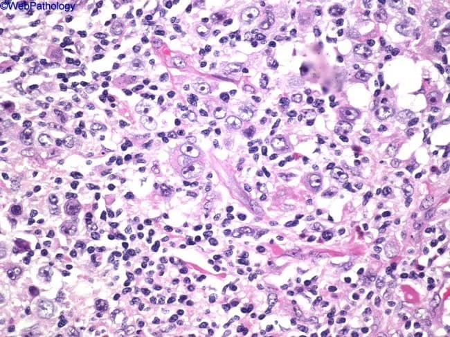 High-power light microscopy of a lymph node biopsy stained with hematoxylin and eosin (H&E) reveals classical Reed-Sternberg (RS) cells and mononuclear variants embedded in a polymorphic inflammatory background. The RS cells are large, often binucleate with prominent eosinophilic nucleoli arranged in an 'owl’s eye' configuration, accompanied by occasional multinucleated giants. In this image, RS cells demonstrate ample cytoplasm and well-defined nuclear membranes, set among a mixed admixture of lymphocytes, eosinophils, plasma cells, and histiocytes. The overall architectural pattern shows nodal effacement by neoplastic Hodgkin and reactive tissue elements rather than solid tumor mass formation. The background inflammatory milieu is characteristic of classical Hodgkin lymphoma, with background cytokine milieu promoting eosinophil recruitment and histiocytic activity. Immunophenotypically, RS cells typically express CD30 and CD15 with weak PAX5 and lack CD45, supporting a diagnosis of classical Hodgkin lymphoma (nodular sclerosis, mixed cellularity, or other subtypes). Clinically, findings correlate with painless lymphadenopathy and potential B symptoms (fever, night sweats, weight loss). This image is diagnostically significant, illustrating the defining microscopic features necessary to differentiate Hodgkin from non-Hodgkin lymphomas and infectious lymphadenitis. It informs differential diagnosis, guides immunohistochemical workup, and underpins treatment planning and prognostic assessment.