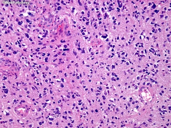 This image depicts a hematoxylin and eosin stained brain tissue section illustrating a glioblastoma multiforme (GBM), a WHO grade IV astrocytoma. Acquired by light microscopy, the slide shows high cellular density with marked nuclear pleomorphism and hyperchromasia, reflecting malignant astrocytic transformation. Numerous mitotic figures indicate active cell proliferation. The tumor infiltrates the surrounding neuropil, producing a markedly fibrillary background characteristic of astrocytic processes. In classic GBM, one may observe necrosis with pseudopalisading and microvascular proliferation, though the specific field here emphasizes the solid hypercellular cast rather than large necrotic zones. The presence of pleomorphic, irregular nuclei with prominent nucleoli and a disordered architectural arrangement confirms an infiltrative glioma of astrocytic lineage. Immunohistochemical confirmation is typically sought (GFAP positivity; IDH-wildtype in primary GBMs; MGMT promoter methylation status informs prognosis and therapy). Clinically, GBM carries a poor prognosis but requires definitive histological grading to guide treatment strategies, including maximal safe surgical resection followed by radiotherapy and temozolomide. This image is valuable for educational context in neuropathology, tumor biology, grading criteria, differential diagnosis with anaplastic astrocytoma or oligodendroglioma, and radiologic-pathologic correlation studies. This example underscores the importance of correlating histology with imaging features for accurate prognosis, therapy planning, and research into glioma biology.