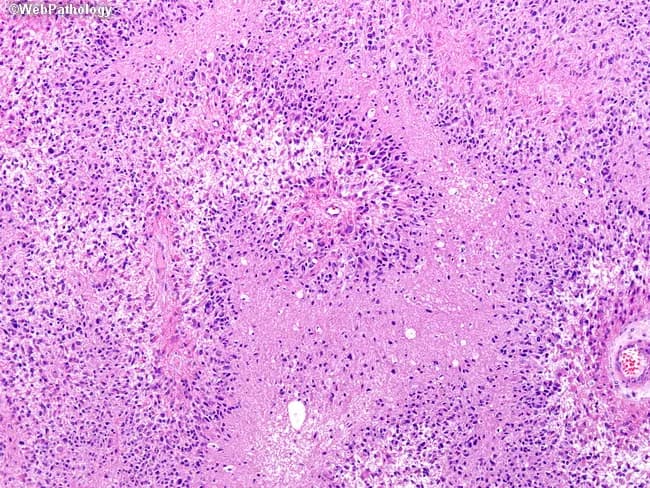 Histopathology image illustrating classic glioblastoma multiforme (GBM) architecture on an H&E stained brain tissue section. Microscopically, necrotic zones are evident and organized in serpentine, finger‑like channels that slice through the cellular matrix. Surrounding the necrosis, hypercellular, pleomorphic tumor cells crowd the periphery and frequently align in pseudopalisading arrangements, creating a distinctive columnar belt of tumor nuclei encircling the dead core. The intermingling of viable glial cells with necrotic debris produces a heterogeneous pattern characterized by dense cellularity, nuclear atypia, mitotic figures, and zones of microvascular proliferation that may be observed at higher magnification. The background stroma shows a mix of capillary networks and microhemorrhages, consistent with aggressive infiltration into adjacent brain parenchyma. This histology reflects the INFILTRATIVE nature of GBM and the hallmark combination of necrosis with pseudopalisading tumor cells. Clinically, these features correlate with rapid clinical progression, resistance to therapy, and a poor prognosis despite aggressive treatment. The image emphasizes the necessity of accurate histological grading (WHO grade IV) to guide multidisciplinary management, including maximal safe surgical resection, adjuvant radiotherapy, and chemotherapy. Recognition of serpentine and geographic necrosis, along with pseudopalisading cells, supports a GBM diagnosis and informs differential considerations such as anaplastic astrocytoma and other high‑grade gliomas. Variants.