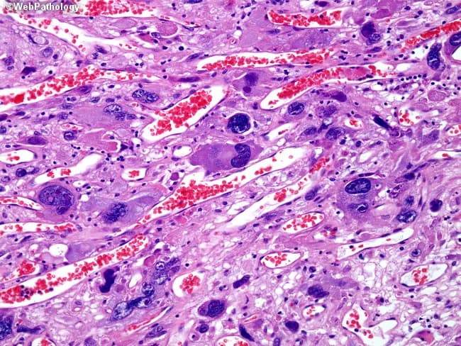 This histopathology image depicts a high-grade astrocytic neoplasm, specifically glioblastoma with giant cells (giant cell glioblastoma/monstrocellular glioblastoma). Prepared as a formalin-fixed paraffin-embedded brain tissue section, stained with Hematoxylin and Eosin (H&E) and examined under light microscopy at variable magnification (commonly 200–400x for cellular detail). The field shows numerous pleomorphic, giant astrocytic cells containing bizarre hyperchromatic nuclei, sometimes multinucleated, with abundant eosinophilic to pale cytoplasm. Tumor cells are embedded within a fibrillary glial background and interspersed with irregular, thickened blood vessels; microvascular proliferation is evident. Regions of necrosis with pseudopalisading necrosis are present, a hallmark of glioblastoma. Numerous mitotic figures may be observed, indicating active tumor proliferation. Intervening red blood cells in capillary channels are visible. The image demonstrates classic glioblastoma features: infiltrative growth, marked cellular pleomorphism, necrosis, microvascular proliferation, and astrocytic differentiation evidenced by GFAP-immunophenotypic concordance (implied). Clinically, this finding correlates with aggressive CNS malignancy in adults, presenting with seizures or focal deficits; treatment involves multidisciplinary management (maximal safe surgical resection, radiotherapy, temozolomide). Diagnostic significance includes distinguishing giant cell GBM variant from conventional GBM and other astrocytomas; prognosis is poor, though some studies suggest variable outcomes in co-occurring mutations. Consideration for targeted molecular profiling and immunohistochemistry is implied, and may guide prognosis and therapy decisions.