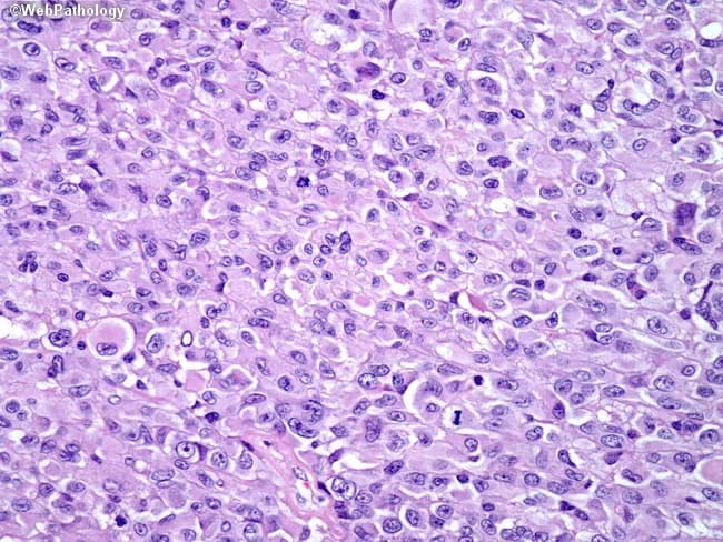 This is a brightfield histopathology image of a brain tumor tissue section, stained with hematoxylin and eosin. The specimen is from a 26-year-old female with left temporal lobe mass on MRI and presenting with headaches and sudden-onset hearing loss. The tumor demonstrates epithelioid glioblastoma morphology characterized by cells with abundant eosinophilic cytoplasm, vesicular nuclei with conspicuous nucleoli, and distinct cell borders. These tumor cells are arranged in cohesive, patternless sheets rather than classic glial fascicles. Necrosis and endothelial proliferation are present, accompanied by brisk mitotic activity, indicating high-grade malignancy. Immunophenotype shows strong GFAP positivity, weak CAM5.2 staining, and lack of melanoma-associated markers, supporting glial origin and arguing against metastatic melanoma or carcinoma. Approximately half of epithelioid GBMs harbor BRAF V600E mutations, a molecular feature with potential therapeutic implications; targeted therapy with BRAF inhibitors (e.g., vemurafenib) may be beneficial in mutation-positive cases. The described histology correlates with an aggressive phenotype and poor prognosis compared with conventional GBM, although targeted molecular therapy may modify outcomes. This image highlights diagnostic challenges where epithelioid features mimic metastatic carcinomas or melanoma, underscoring the need for immunohistochemistry and molecular profiling for accurate diagnosis and treatment planning. Clinical relevance includes guiding molecularly targeted therapy decisions for care.