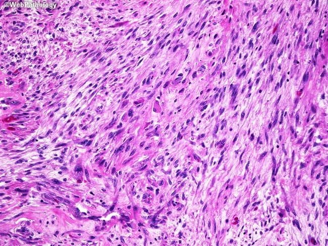 Imaging modality: Light microscopy of hematoxylin and eosin stained brain tumor tissue (formalin-fixed, paraffin-embedded; micrograph). The slide illustrates a gliosarcoma, a rare primary CNS neoplasm consisting of two malignant components: a glial, astrocytic element resembling glioblastoma and a mesenchymal, spindle-cell sarcomatous element. The histologic pattern is biphasic, with areas of highly cellular, pleomorphic astroglial cells showing brisk mitotic activity and microvascular proliferation, and separate fascicles of spindle-shaped cells with elongated nuclei, abundant eosinophilic cytoplasm, and occasional atypia. Notable features include necrosis with potential pseudopalisading arrangements in glial regions and intermingled mesenchymal regions that may exhibit collagen deposition. Immunophenotypic separation is typical, with GFAP positivity in glial areas and vimentin positivity in sarcomatous zones, reflecting divergent lineages within a single tumor. The overall architecture and cellular morphology support a high-grade, aggressive neoplasm; differential diagnoses include conventional glioblastoma, metastasis with sarcomatoid features, and other high-grade CNS tumors with mesenchymal differentiation. Clinically, gliosarcoma mirrors glioblastoma in epidemiology, presentation, and prognosis but may show a slight temporal lobe predilection. Diagnostic significance lies in recognizing biphasic histology, guiding surgical management and adjuvant therapy, and informing prognosis. This image emphasizes tumor heterogeneity and the need for combined histological and immunohistochemical confirmation to guide targeted therapy decisions.