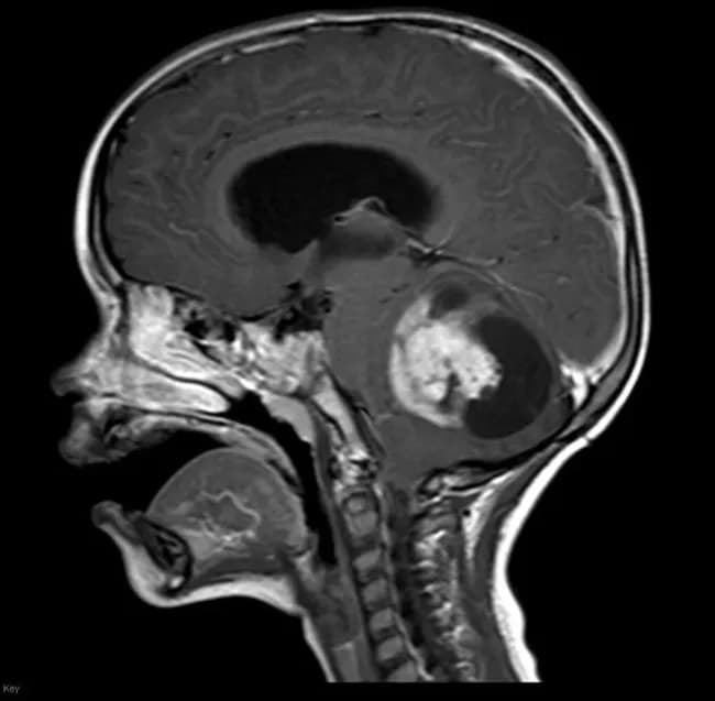 Sagittal gadolinium enhanced MRI of the brain in a 3 year old male demonstrates a large cystic lesion in the cerebellum with a conspicuously enhancing mural nodule. The mass is located in the posterior fossa, displacing adjacent cerebellar tissue and potentially affecting CSF pathways. The imaging signature, a cystic lesion with a solid, brightly enhancing mural nodule, is a classic pattern for pilocytic astrocytoma (juvenile pilocytic astrocytoma, JPA) in children. On T1 and T2 weighted sequences the cyst component typically shows low to intermediate signal with the mural nodule displaying solid enhancement after contrast administration. The border is well circumscribed, and peritumoral edema is minimal, reflecting a low grade glioma. Differential considerations include medulloblastoma and ependymoma, but age, tumor location, and the cyst plus nodule morphology strongly favor PA. Clinically, this pattern guides surgical planning toward maximal safe resection, which offers favorable prognosis in pediatric PA. Correlation with histology would reveal biphasic pilocytic architecture and Rosenthal fiber positive astrocytic cells. This case courtesy of Radiopaedia serves as an educational example of posterior fossa cystic neoplasms in children. Keywords: pediatric brain tumor, cerebellar tumor, posterior fossa, cystic lesion, enhancing mural nodule, gadolinium, MRI, prognosis, resection. Educationally relevant for learners and clinicians worldwide.
