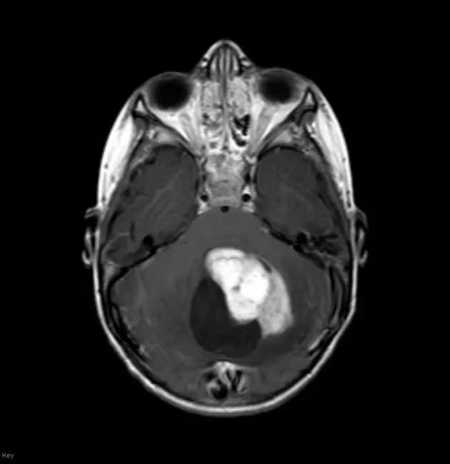 Magnetic Resonance Imaging (MRI) of the brain, coronal view with gadolinium-based contrast. The patient is a 3-year-old male. The imaging demonstrates a large cystic cerebellar mass within the posterior fossa with a nodular mural enhancement projecting from the cyst wall. The mural nodule enhances brightly after contrast, contrasting with a comparatively non-enhancing predominant cystic component. The lesion arises within the cerebellar hemisphere (posterior fossa), causing surrounding cerebellar parenchymal involvement and mild mass effect; the fourth ventricle is partially compressed but hydrocephalus is not evident on this slice. The imaging phenotype—cystic cerebellar lesion with an intensely enhancing mural nodule in a young child—is classic for pilocytic astrocytoma. Alternative considerations include other cerebellar tumors seen in children such as medulloblastoma, ependymoma, and hemangioblastoma, though age, location, and imaging pattern favor pilocytic astrocytoma. These tumors may present with cystic components and mural nodules, but pilocytic astrocytoma typically presents as a circumscribed, cystic lesion with a well-defined, enhancing mural nodule. Clinically, pilocytic astrocytoma is generally WHO grade I with favorable prognosis following surgical resection; radiologic follow-up and clinical correlation with histopathology are essential. This case aligns with the typical pediatric posterior fossa pilocytic astrocytoma presentation and is suitable for surgical planning and prognosis assessment.