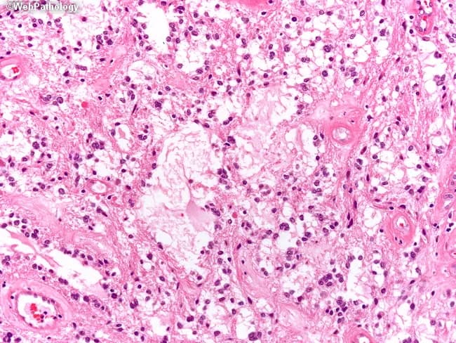 This is a high-magnification histopathology image (Hematoxylin and Eosin stain) of pilocytic astrocytoma, a World Health Organization Grade 1 glioma. The tissue shows biphasic architecture with microcystic, loose backgrounds interposed with compact, piloid areas composed of spindle-shaped astrocytic cells bearing long, hair-like processes. The cellular regions resemble fibrillary astrocytoma but are distinguished by their abundant, slender cytoplasmic processes and cohesive, monomorphic nuclei with minimal atypia. Rosenthal fibers—eosinophilic, corkscrew-like inclusions—may be evident within the fibrillary matrix. The microcystic zones contain small vacuolated spaces; vessels are typically capillary and inconspicuous. Overall, there is low mitotic activity, absent necrosis, and mild nuclear pleomorphism, all supportive of a benign, slow-growing tumor. Clinically, pilocytic astrocytomas arise predominantly in children, most commonly in the posterior fossa, but can involve cerebral hemispheres or spinal cord; neurofibromatosis type 1 predisposes to optic pathway gliomas. The lesion’s image-based histology correlates with favorable prognosis after gross total resection and a low recurrence rate. Differential diagnoses include fibrillary astrocytoma, oligodendroglioma, ganglioglioma, and DNET; however, the biphasic microcystic/piloid pattern, Rosenthal fibers, and low-grade cytology strongly support pilocytic astrocytoma. This slide aids diagnostic confirmation and informs surgical planning and prognostic assessment. Knowledge of this pattern guides tailored therapy and long-term surveillance, improving outcomes.