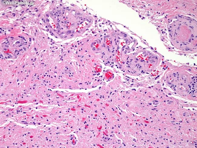 Brightfield hematoxylin and eosin stained brain tumor tissue (FFPE) illustrating pilocytic astrocytoma morphology. The tumor shows cystic architecture with loose, interspersed piloid astrocytes, featuring hair-like processes and elongated bipolar cells. Adjacent solid areas merge with the cyst wall, creating a biphasic pattern typical of pilocytic astrocytoma. A prominent feature is glomeruloid microvascular proliferation: tortuous, lumen-rich endothelial tufts with multiple lumina arranged around cystic spaces. While rare multilayered endothelial hyperplasia can occur in pilocytic astrocytoma, it does not impart the ominous prognostic significance seen in diffuse high-grade gliomas. Rosenthal fibers are present in the lower portion of the image as brightly eosinophilic, thick, corkscrew-like inclusions within astrocytic processes. The background matrix shows microcystic change and a mild inflammatory infiltrate; mitotic activity is rare and nuclear atypia minimal, consistent with a low-grade glioma. Overall, the histology supports a diagnosis of pilocytic astrocytoma in a cyst-containing cerebral lesion. The documented features—piloid cells, Rosenthal fibers, and glomeruloid vessels—are critical for differential diagnosis, helping distinguish from high-grade gliomas where endothelial hyperplasia carries grave prognosis. Correlation with age, imaging, and clinical course is essential to confirm the diagnosis and guide management.