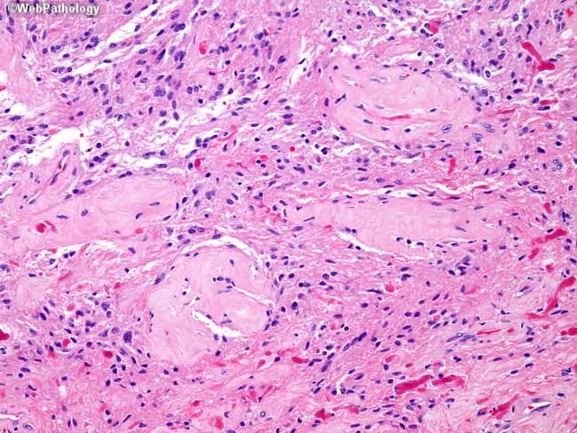 This histopathology image shows pilocytic astrocytoma tissue characterized by a biphasic architecture with alternating dense, fibrillary areas and looser, microcystic regions. The tumor cells are astrocytic with long, hairlike processes and piloid cytoplasm, arranged in bipolar, threadlike formations. Rosenthal fibers—eosinophilic, elongated inclusions within processes—are evident, contributing to the diagnostic pattern. Vascular hyalinization is conspicuous, with thickened blood vessel walls persisting amidst the tumor. Occasional infarct-like necrosis may be present in a minority of cases (5–10%), though the image primarily demonstrates viable tumor. The background shows a mixed inflammatory infiltrate and microglial activation in some fields. The staining is hematoxylin and eosin, highlighting nuclei in dark blue/purple against pink eosinophilic cytoplasm and connective tissue; mitotic figures are rare, consistent with a low-grade neoplasm. Clinically, pilocytic astrocytomas are associated with MAPK pathway activation, frequently via BRAF alterations or FGFR1/PTPN11 mutations, underscoring the genetic etiology described in contemporary genomics studies. The histologic silhouette supports a low-grade glioma diagnosis with favorable prognosis following gross-total resection; differential considerations include pilomyxoid astrocytoma and oligodendroglioma in atypical presentations. This image exemplifies key diagnostic features used in neuropathology practice and research, as well as molecular correlation with targeted therapies.
